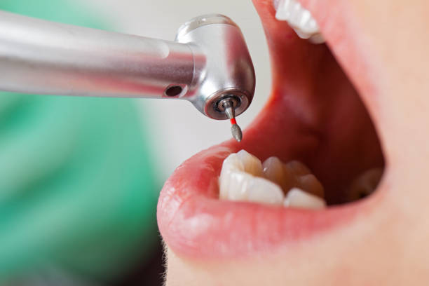 Emergency Dental Filling Replacement in NY